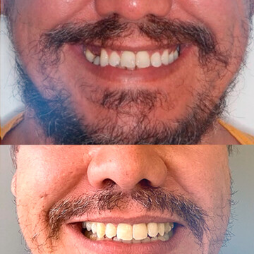 Caso Clínico de Leopoldo: Perda Dentária e Impactos na Qualidade de Vida