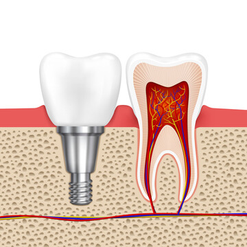 Fratura de Raiz Dentária: Tratamento Inovador com Dr. Daniel Jacques