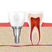 Fratura de Raiz Dentária: Tratamento Inovador com Dr. Daniel Jacques