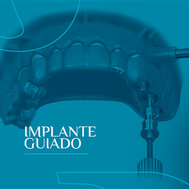 Implante Guiado