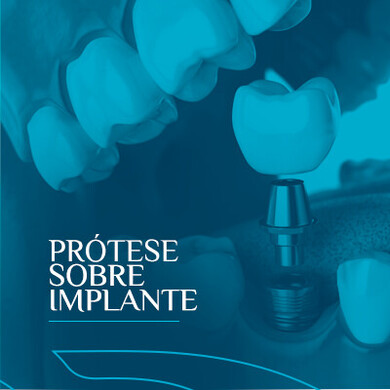 Prótese Sobre Implante