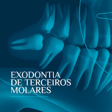 Exodontia de Terceiros Molares